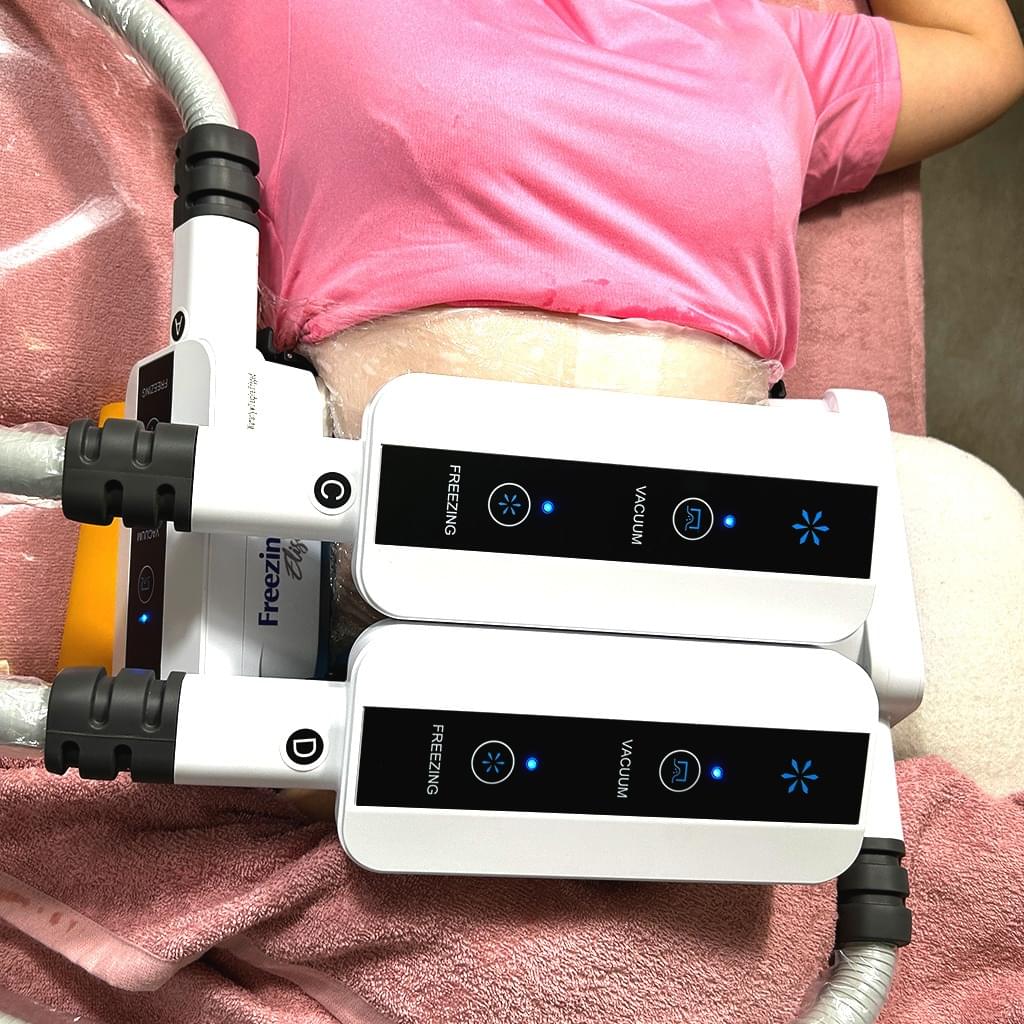 脂肪冷却マシンでお腹の部分痩せ施術を受ける女性